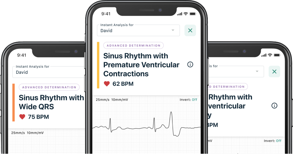 Aplikacja pokazuje EKG z sinusowym rytmem serca i przedwczesnymi skurczami komorowymi